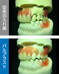 バルプラスト義歯とは？